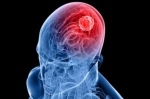 Zika virus used to treat aggressive brain cancer – BBC News